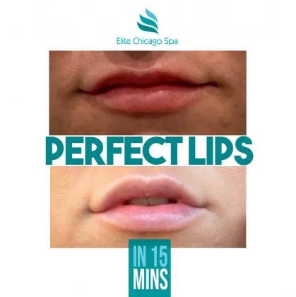 Los mejores rellenos de labios Chicago cerca de mí